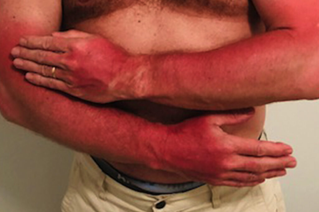 Peter Hinman's sun burned arms after a day in the sun at Biscayne National Park Biscayne Bay